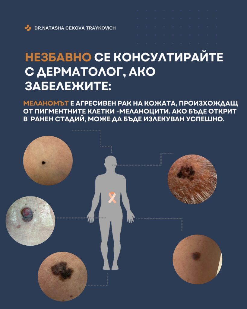 Меланоми