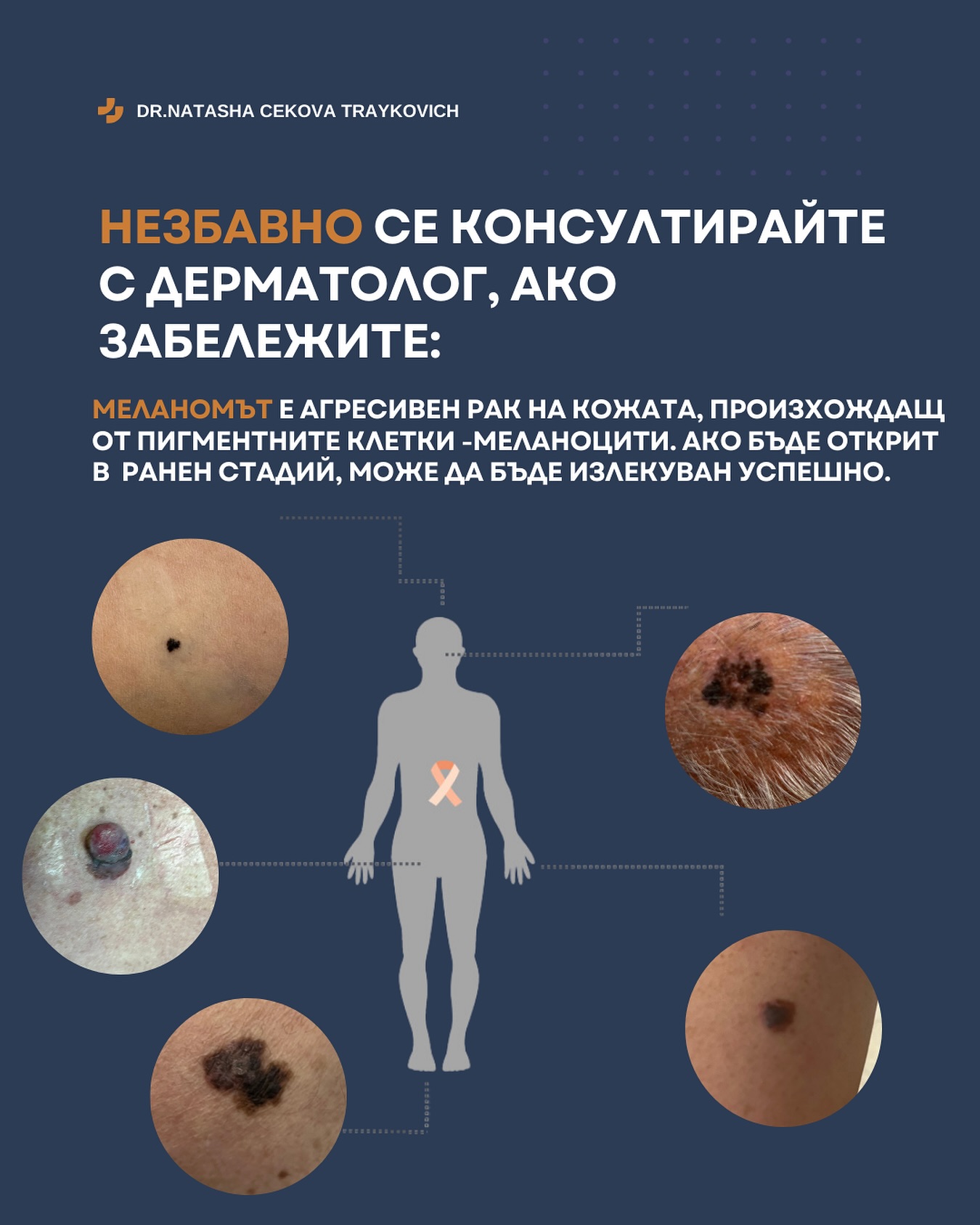 Меланоми