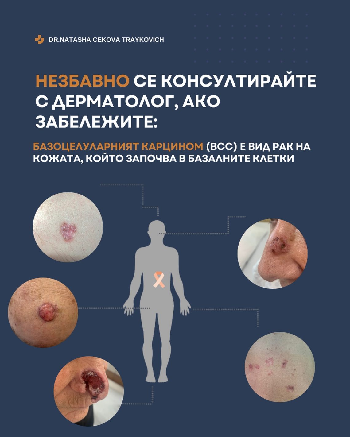 Базоцелуларният карцином (BCC) е вид рак на кожата, който започва в базалните клетки.